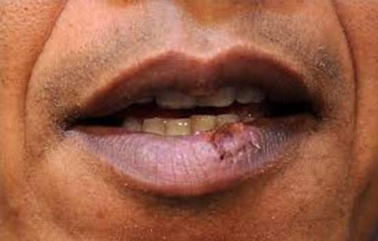 Home Remedies for cold sores