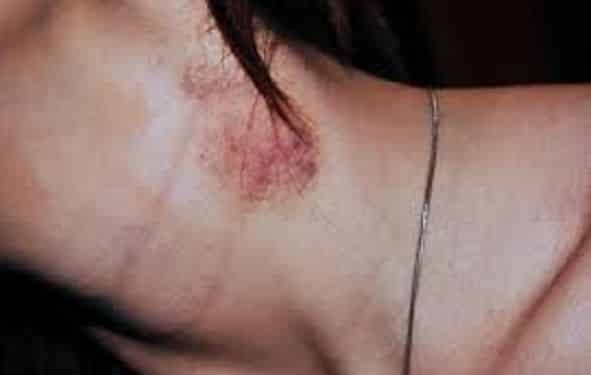 how to get rid of a hickey