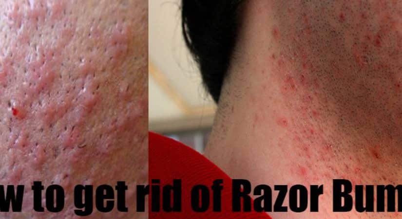 how to get rid of razor bumps fast