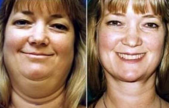 How to lose face fat fast